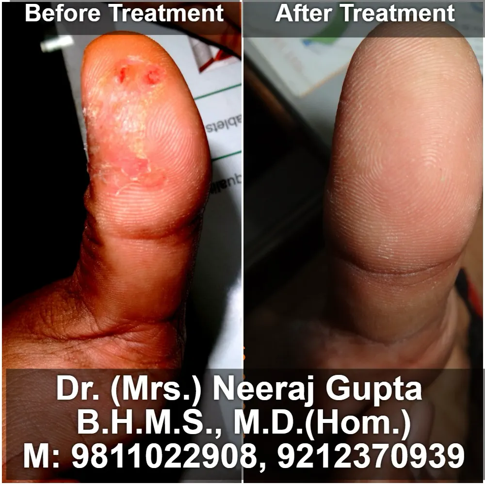 Alopecia Areata (Patchy Hair Loss)