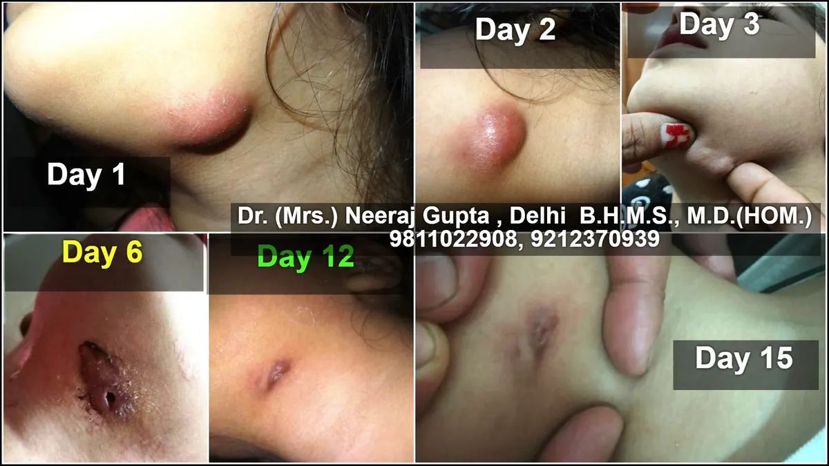Hypertrophic Keloid Scar Remodeling
