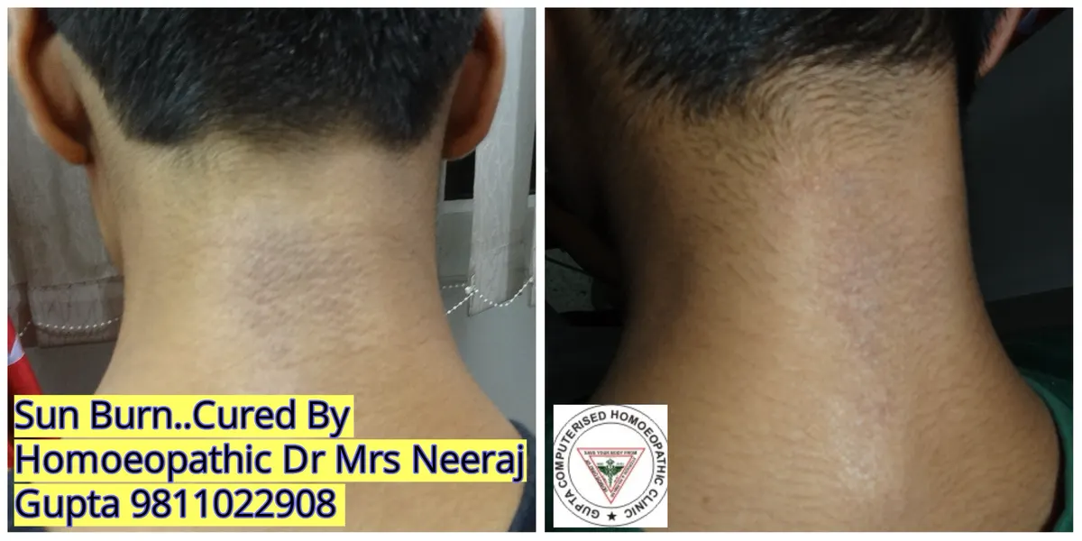 Chronic Nummular Eczema Recovery