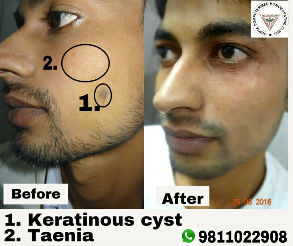 Segmental Vitiligo Repigmentation