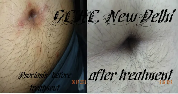 Hormonal Facial Melasma (Chloasma)