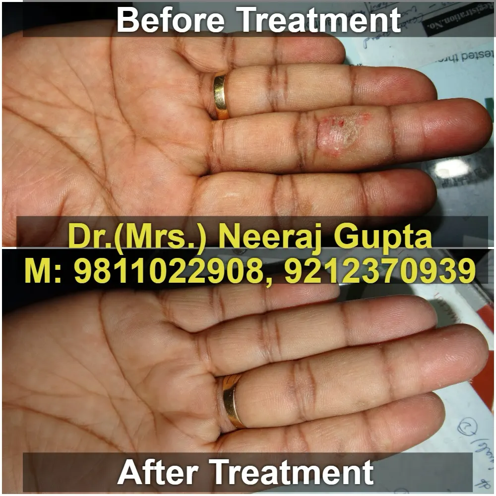 Severe Nodulocystic Acne