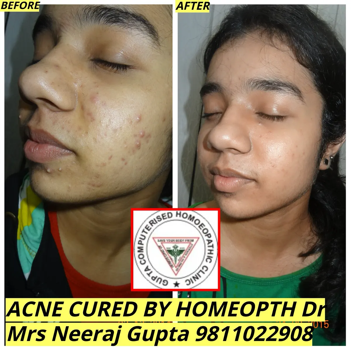 Fungal Infection Treatment