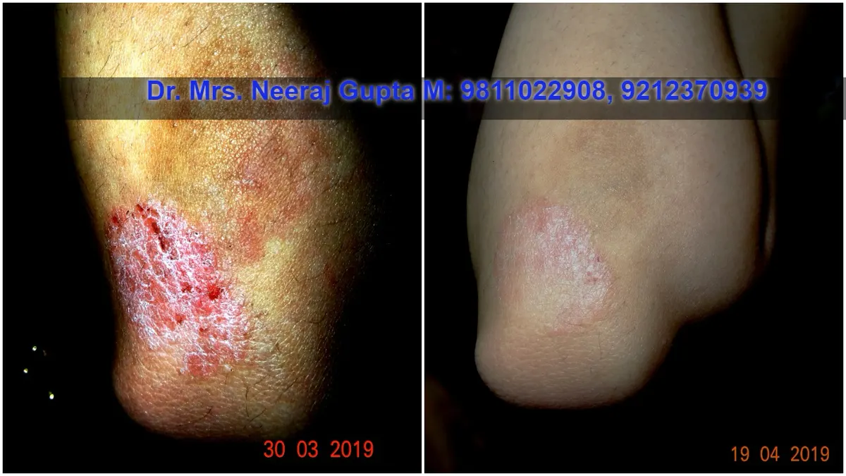 Wart Removal Success