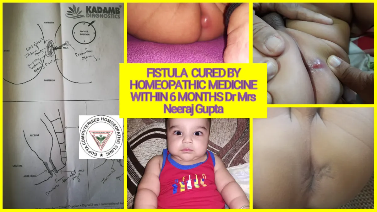 Chronic Idiopathic Urticaria (Hives)